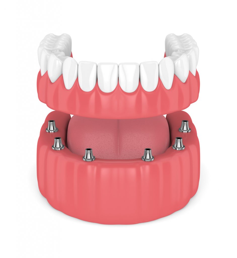 Dental Implant Bridge.
