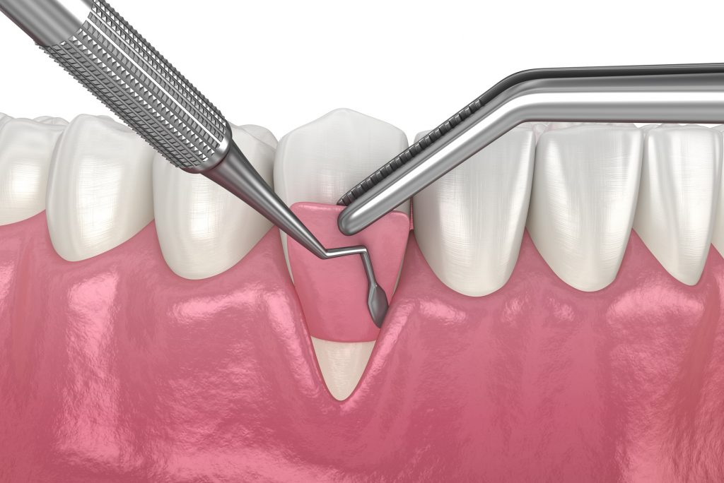 Gum Recession Soft tissue graft surgery periodontal therapy