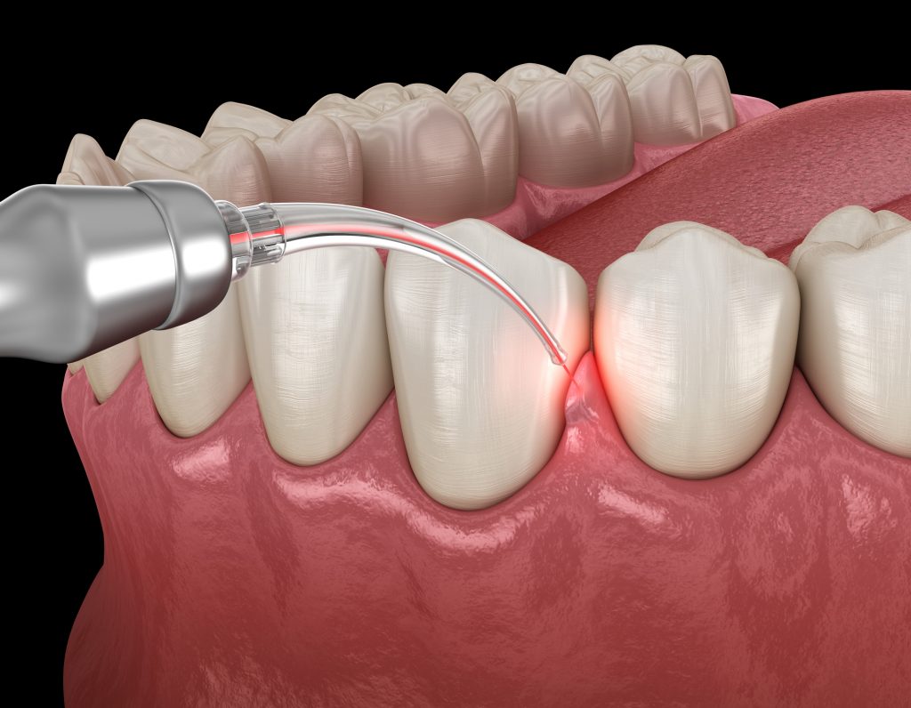 Gum correction surgery with laser.
