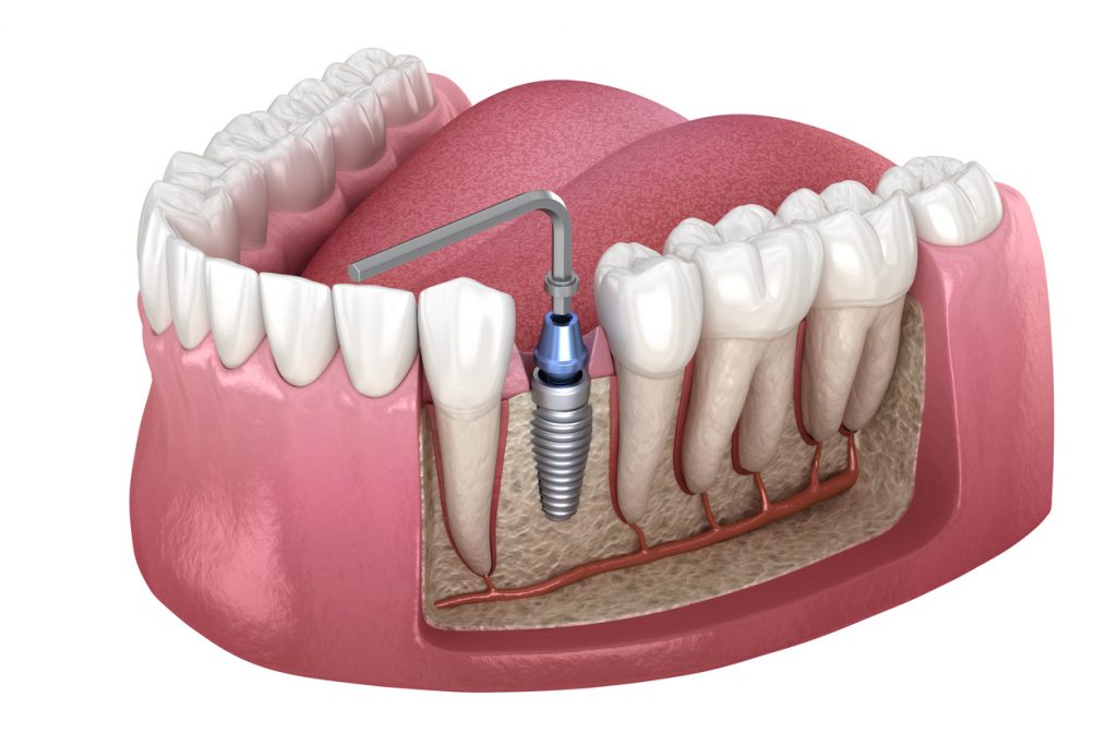 Implant abutment fixation procedure. Medically accurate 3D illustration of human teeth and dentures concept