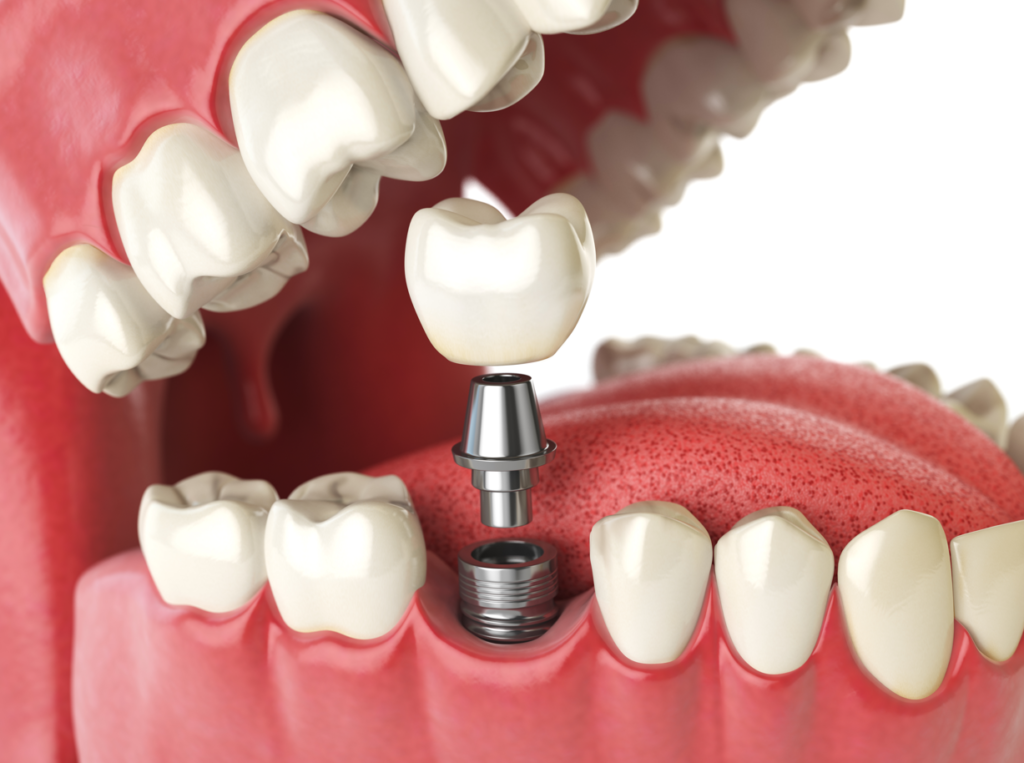 Alpine Dental Implants